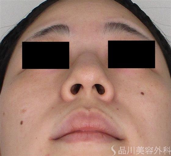 症例NO.59198のBEFORE写真