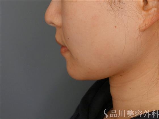 症例NO.59918のBEFORE写真