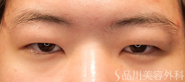 症例NO.72319のBEFORE写真