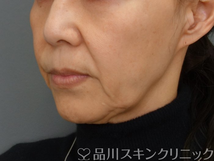 症例NO.74804のBEFORE写真