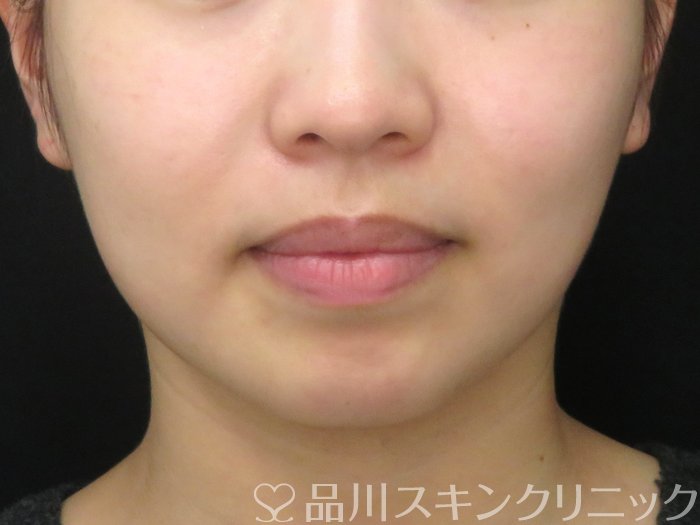 症例NO.69472のAFTER写真