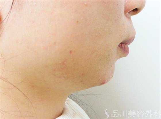 症例NO.33010のBEFORE写真