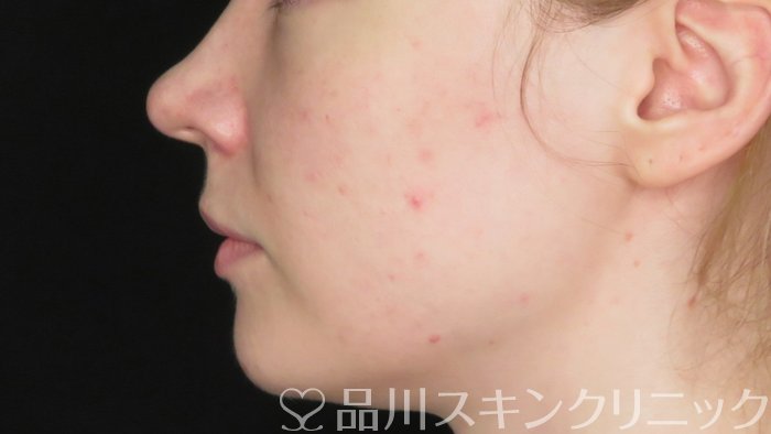 症例NO.71268のBEFORE写真