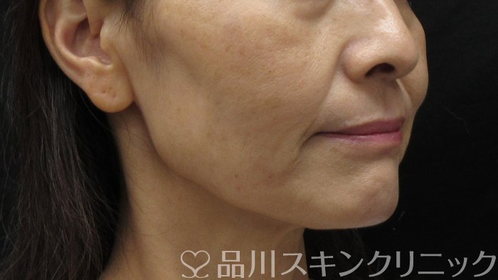 症例NO.71434のAFTER写真