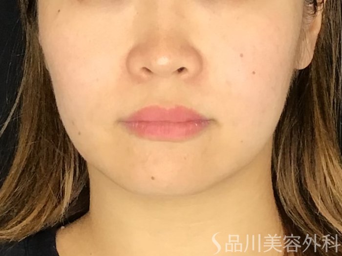 症例NO.67829のBEFORE写真