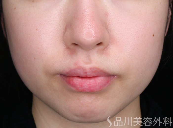 症例NO.75030のAFTER写真