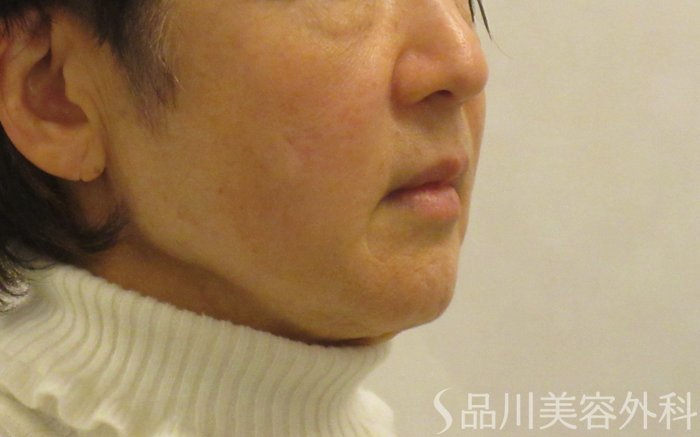 症例NO.69070のBEFORE写真