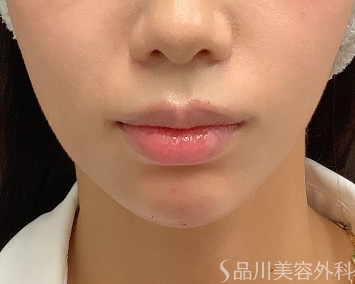 症例NO.75339のAFTER写真