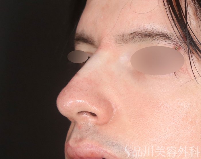 症例NO.72932のAFTER写真