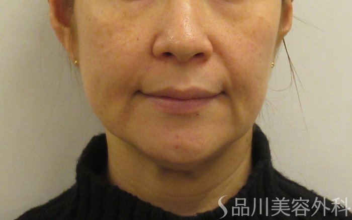 症例NO.72214のBEFORE写真