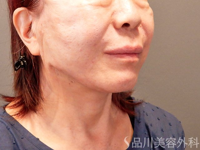 症例NO.71190のAFTER写真