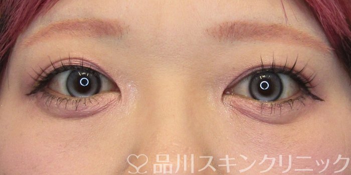 症例NO.74910のAFTER写真