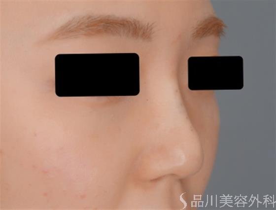 症例NO.54902のAFTER写真