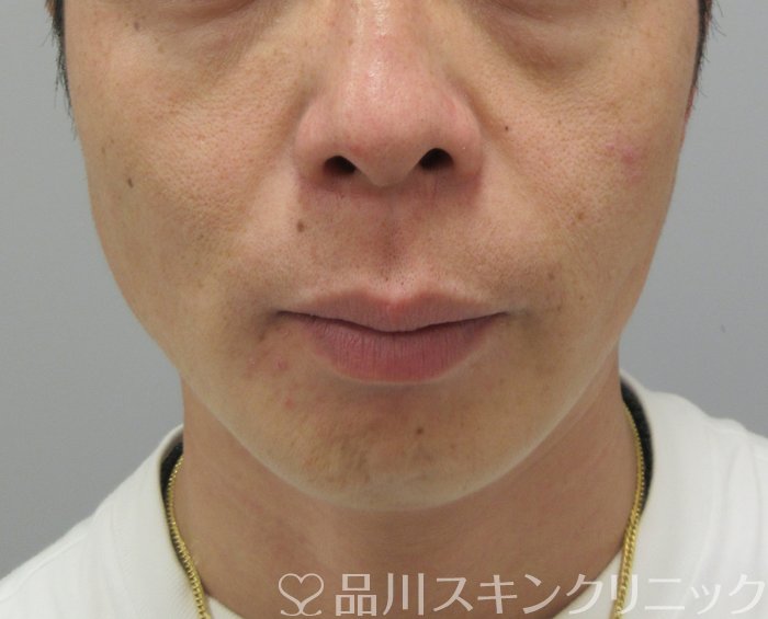 症例NO.73746のAFTER写真