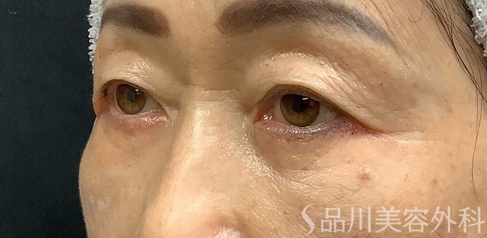 症例NO.69668のAFTER写真