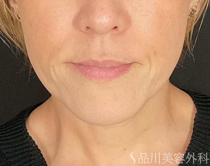 症例NO.74793のBEFORE写真