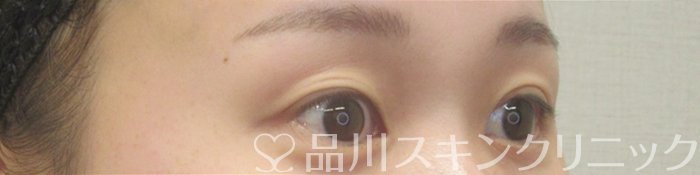 症例NO.73938のBEFORE写真