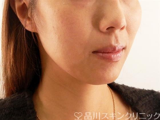 症例NO.57699のBEFORE写真