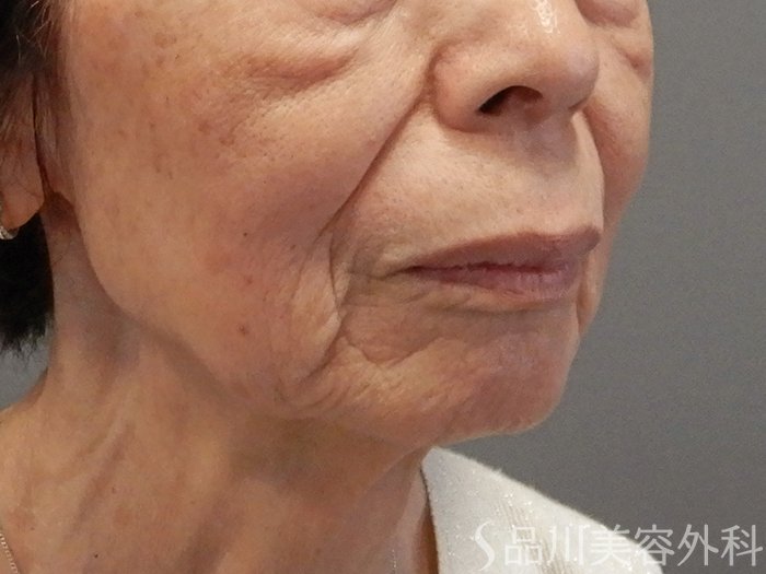 症例NO.70358のBEFORE写真