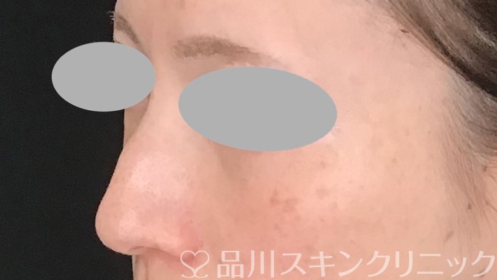 症例NO.63806のBEFORE写真