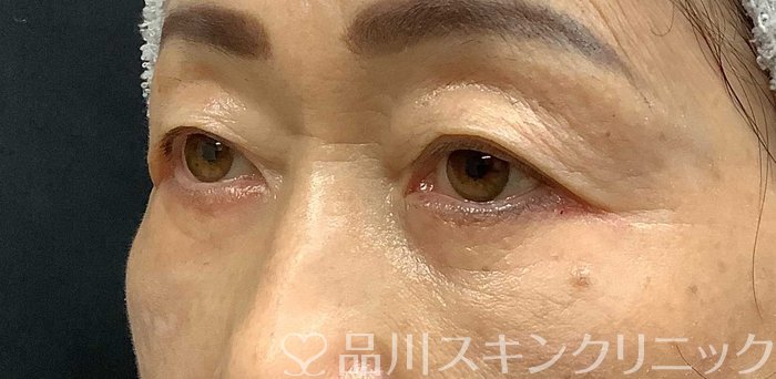 症例NO.69668のAFTER写真