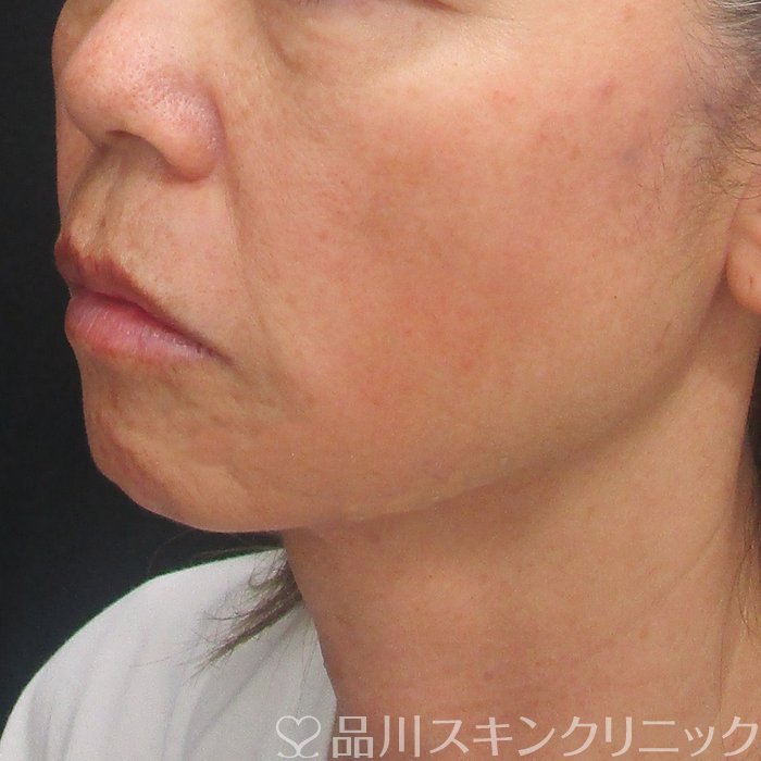 症例NO.73962のAFTER写真