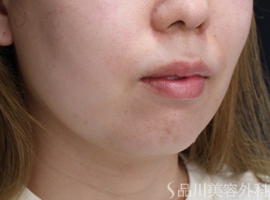 症例NO.70670のBEFORE写真