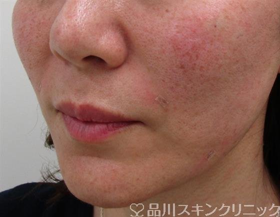 症例NO.34060のAFTER写真