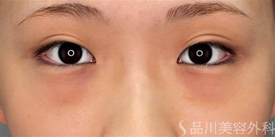 症例NO.54435のBEFORE写真