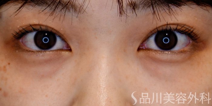 症例NO.69751のBEFORE写真