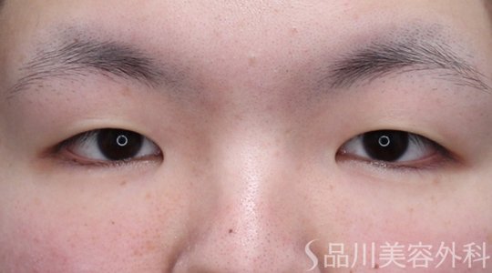 症例NO.73559のBEFORE写真