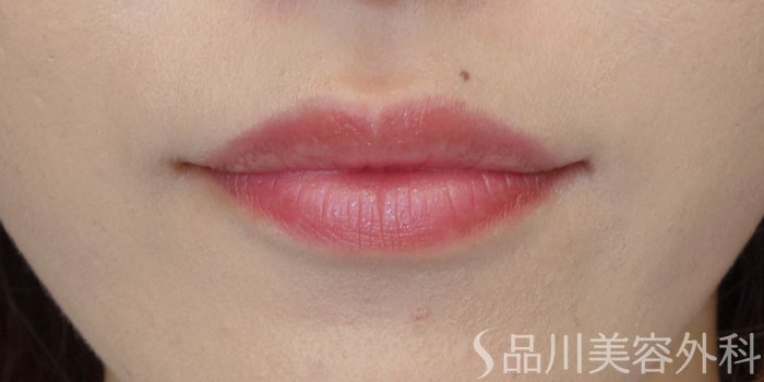 症例NO.71519のBEFORE写真