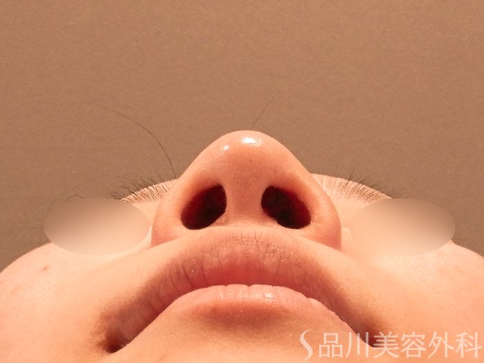 症例NO.70517のBEFORE写真