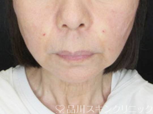 症例NO.74669のAFTER写真