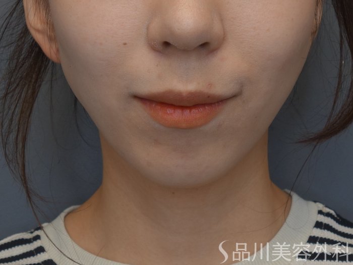 症例NO.74638のBEFORE写真