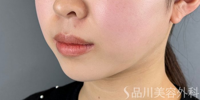 症例NO.65605のBEFORE写真