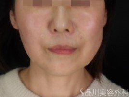 症例NO.73524のAFTER写真