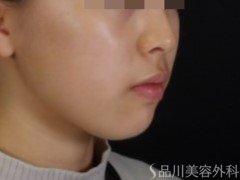 症例NO.72533のBEFORE写真