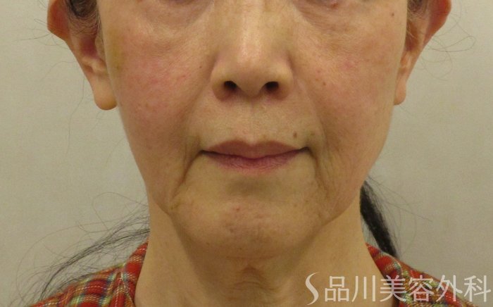 症例NO.65494のBEFORE写真