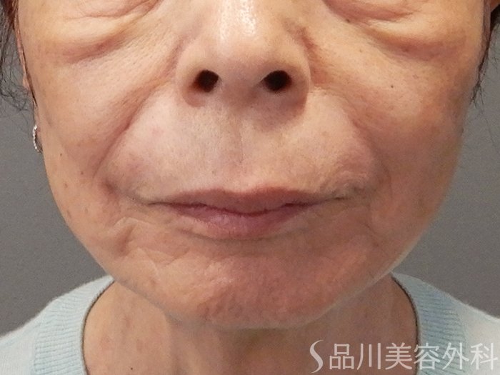 症例NO.70358のAFTER写真