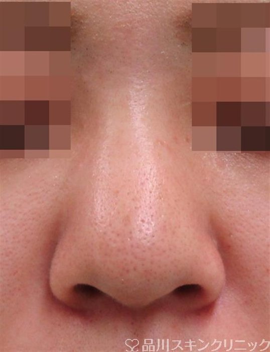 症例NO.32660のBEFORE写真