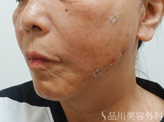 症例NO.73210のAFTER写真