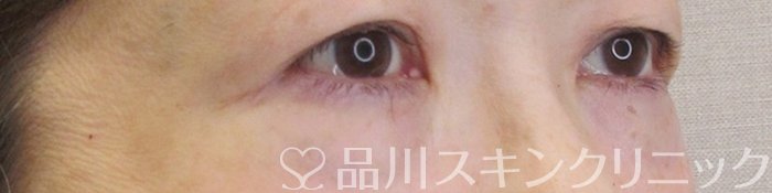 症例NO.70908のBEFORE写真
