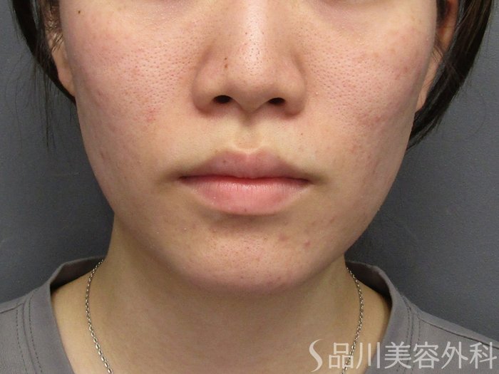 症例NO.75113のBEFORE写真