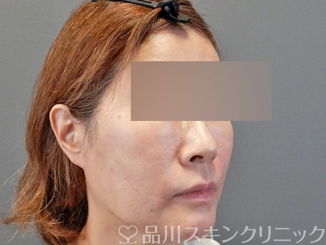 症例NO.66270のAFTER写真