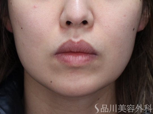 症例NO.73334のBEFORE写真