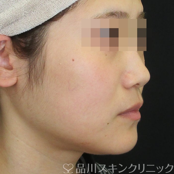 症例NO.74987のBEFORE写真