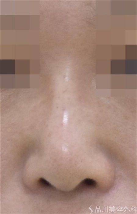 症例NO.50010のAFTER写真