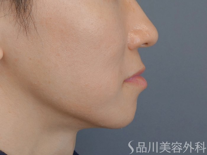 症例NO.73081のBEFORE写真