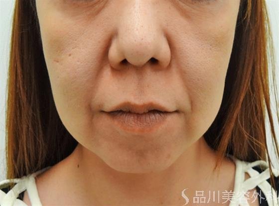 症例NO.25029のBEFORE写真